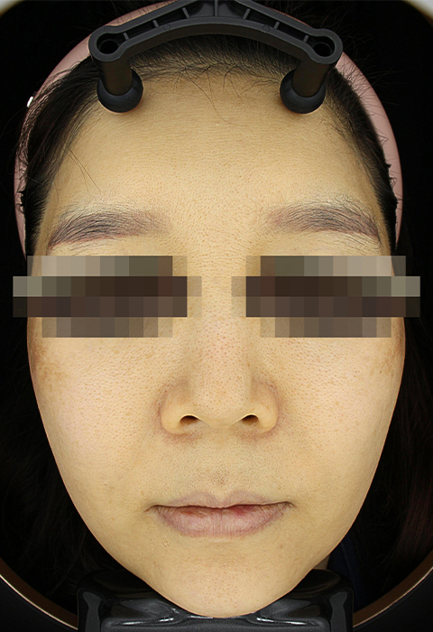 before이미지