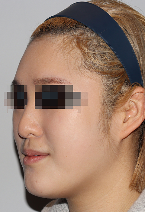 before이미지