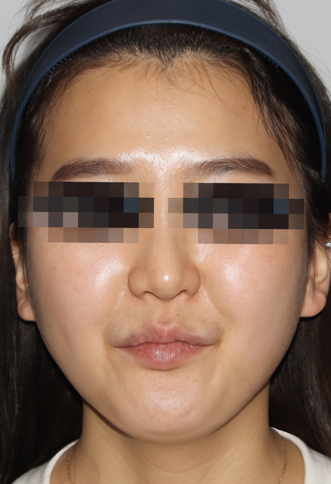 before이미지